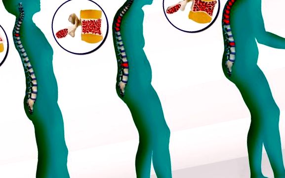 Modificări ale coloanei vertebrale în osteoporoză