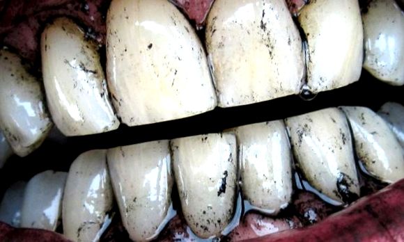 Albirea dinților cu cărbune