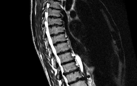 Tomografie computerizată a coloanei vertebrale