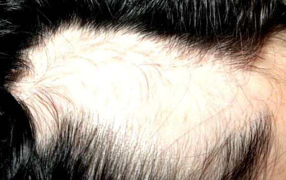 Tratamentul alopeciei
