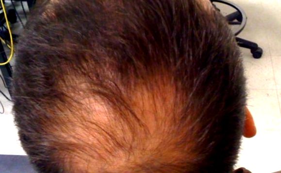 Alopecia - chelie