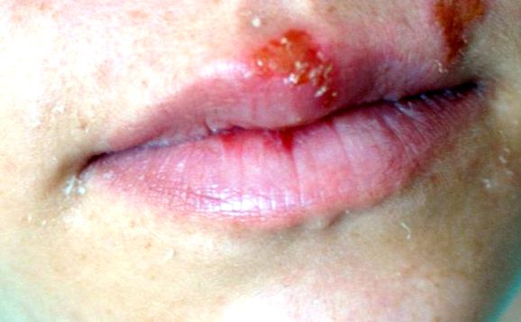 Herpes - leziuni la nivelul buzelor