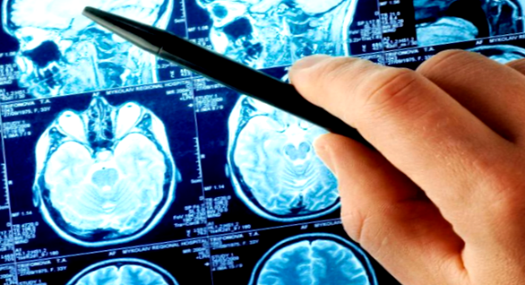 Un accident vascular cerebral cerebral este una dintre cele mai periculoase patologii