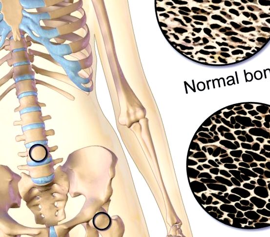 Osteoporoza oaselor