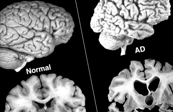 Atrofia creierului în boala Alzheimer