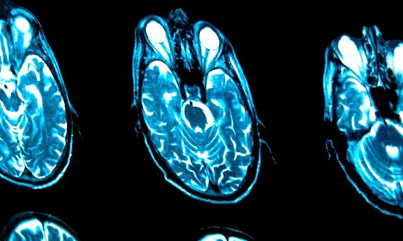 Imagistica (RMN) a creierului