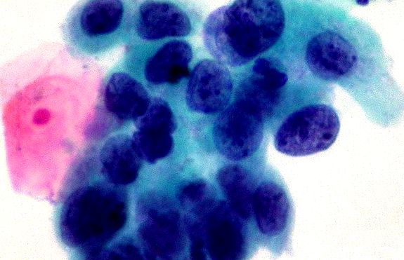 Cancer - Celule tumorale de carcinom