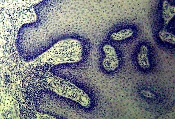 Examinarea histologică a papilomavirusului uman pe piele